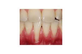 Uitnodiging lezing 18 november: Een recessie is vaak meer dan alleen ‘te weinig gingiva’.