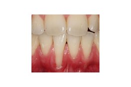Uitnodiging lezing 18 november: Een recessie is vaak meer dan alleen ‘te weinig gingiva’.